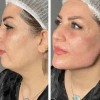 تزریق ژل فیلر لب بادی ‌‌بوتاکس کانتورینگ مزو صورت