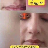 کرم لیفتینگ بینی|آرایشی، بهداشتی، درمانی|رشت, پل تالشان|دیوار