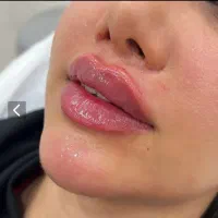 تزریق ژل لب مدل Mبوتاکس چشم گربه ای فیلر بادی