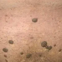 ساده ترین راه برای حذف زگیل