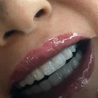 کامپوزیت دندان اقساطی از دم قسط واحدی ۱/۵۰۰