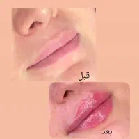 خدمات فیلر زیبایی ،فیشیال تخصصی ،هایفوتراپی|خدمات آرایشگری و زیبایی|زاهدان, |دیوار