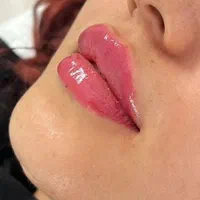 جشنواره تزریق ژل و بوتاکس و لیفت نخ و مزو چربی سوز|خدمات آرایشگری و زیبایی|کرمانشاه, |دیوار
