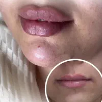 زیبایی چهره هارا ماندگار کن با بوتاکس و فیلر|خدمات آرایشگری و زیبایی|سبزوار, فرهنگیان|دیوار