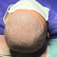 کاشت موی ملورین