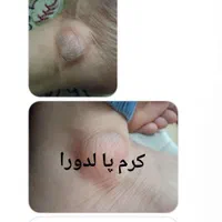 کرم ترک پای قوی لدورا ترمیم سریع ترک و خشکی|آرایشی، بهداشتی، درمانی|لاهیجان, شهید آوینی|دیوار