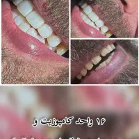 دندانپزشکی / کامپوزیت ونیر ، روکش، جراحی دندان عقل|خدمات آرایشگری و زیبایی|کرج, شهرک بنفشه|دیوار