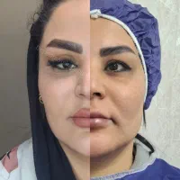 بلفارو پلاستی  با بخیه های نانو لیزری 8/990