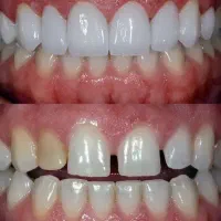 کامپوزیت دندان|خدمات آرایشگری و زیبایی|بناب, |دیوار