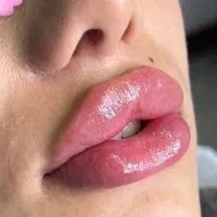 فیلر و بوتاکس توسط پزشک پوست و مو