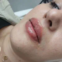 اموزش تزریقات زیبایی بوتاکس و فیلر و مزو|خدمات آموزشی|ارومیه, |دیوار