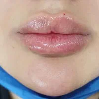 انجام خدمات ژل و بوتاکس|خدمات آرایشگری و زیبایی|اسلامشهر, شهرک مصطفی خمینی|دیوار