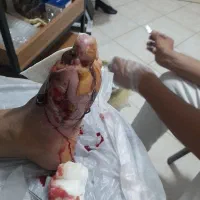 طب سنتی و سوزنی