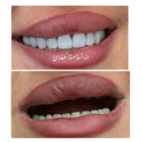دندانسازی سکندری کرمان دندان ایتالیایی لثه نرم|خدمات آرایشگری و زیبایی|کرمان, |دیوار
