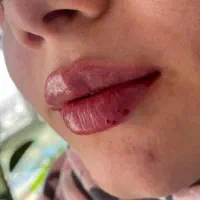 تزریق ژل و بوتاکس و مزوژل