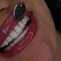 کامپوزیت با ضمانت/ اقساط ویژه