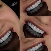 ایمپلنت و کامپوزیت دندان فقط از 10|خدمات آرایشگری و زیبایی|نورآباد, |دیوار