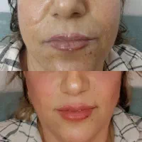 اموزش و خدمات بوتاکس و فیلروفیشیال و فیلر بادی|خدمات آرایشگری و زیبایی|شیراز, کوشک میدان|دیوار