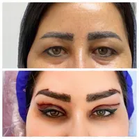 جراحی زیبایی پلک با قیمت مناسب
