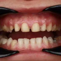 کامپوزیت دندانپزشکی تخفیفه ویژه اقساط چکی|خدمات آرایشگری و زیبایی|تهران, شهرک ولیعصر جنوبی|دیوار
