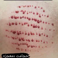 حـجامـت.. بـادکـش درمانی