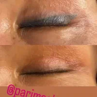 پاک کردن انواع تتو و خالکوبی بالیزر تخصصی کیوسویچ|خدمات آرایشگری و زیبایی|فولادشهر, پارک کوهستان|دیوار