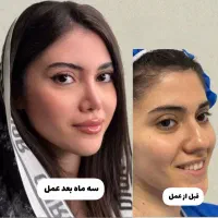 جراحی بینی باقیمت باورنکردنی،فرصت رزروبه مدت 1هفته