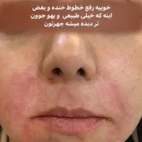 ژل لب فیلر بوتاکس مزو وآنزیم          زیرنظرپزشک|خدمات آرایشگری و زیبایی|مشهد, آزادشهر|دیوار