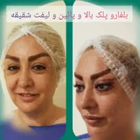 جشنواره پائیزی جراحی پلک.شقیقه.ابرو.سانترال لب.|خدمات آرایشگری و زیبایی|زاهدان, |دیوار