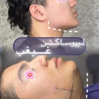 افر فوق العاده لیپوساکشن غبغب و خدمات زیبایی