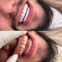 دندانپزشکی کامپوزیت لمینت روکش عصب کشی