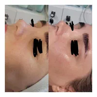 جشنواره فیشال تخصصی پوست پاکسازی + آبرسانی حرفه‌ای|خدمات آرایشگری و زیبایی|زنجان, |دیوار