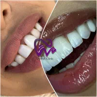 کامپوزیت دندان لبه شیشه ای اقساطی