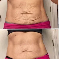 هایفو/لیفت پوست/کانتورینگ صورت/رفع غبغب|خدمات آرایشگری و زیبایی|مسجد سلیمان, |دیوار