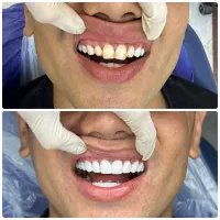 کامپوزیت زیبایی دندان|خدمات آرایشگری و زیبایی|تهران, صادقیه|دیوار