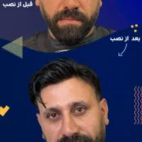 کاشت مو‌بدون جراحی  (پروتز مو‌بدون‌چسب)|خدمات آرایشگری و زیبایی|درگهان, |دیوار