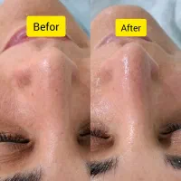 پاکسازی تخصصی پوست و فیشال رامسر