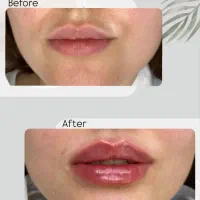 مدل تزریقات زیبایی