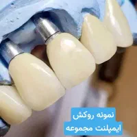 دندانپزشکی ایمپلنت دیجیتال سوئیسی باعکس رایگان|خدمات آرایشگری و زیبایی|مشهد, احمدآباد|دیوار