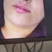 ژل و بوتاکس تضمینی جشنواره پاییزی