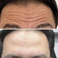 جشنواره ۵۰درصدی ژل و بوتاکس ، ساکشن غبغب|خدمات آرایشگری و زیبایی|کرمانشاه, |دیوار