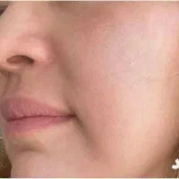 کرم ضد لک. بیوممتیک|آرایشی، بهداشتی، درمانی|تهران, سنائی|دیوار