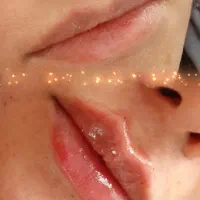 تزریق ژل وبوتاکس در منزل