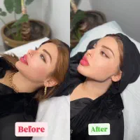 تخلیه چربی غبغب|خدمات آرایشگری و زیبایی|تهران, ایوانک|دیوار