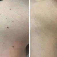 برداشتن خال وزگیل|خدمات آرایشگری و زیبایی|کرمانشاه, |دیوار