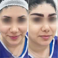 کاشت ابروی طبیعی