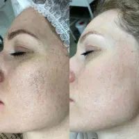 تخفیف ویژه کربن تراپی با پیشرفته ترین دستگاه|خدمات آرایشگری و زیبایی|اهواز, کیانپارس |دیوار
