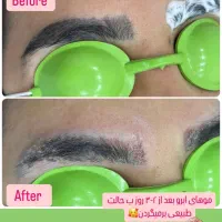 روشن سازی با لیزر پیکوشور و پاک کردن تتو|خدمات آرایشگری و زیبایی|هندیجان, |دیوار