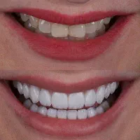 دندانپزشکی/ ایمپلنت و اوردنچر با اقساط دو ساله