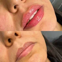 ژل لب به روش M تکنیک